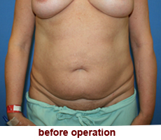 plastic-surgery-tummy-tuck